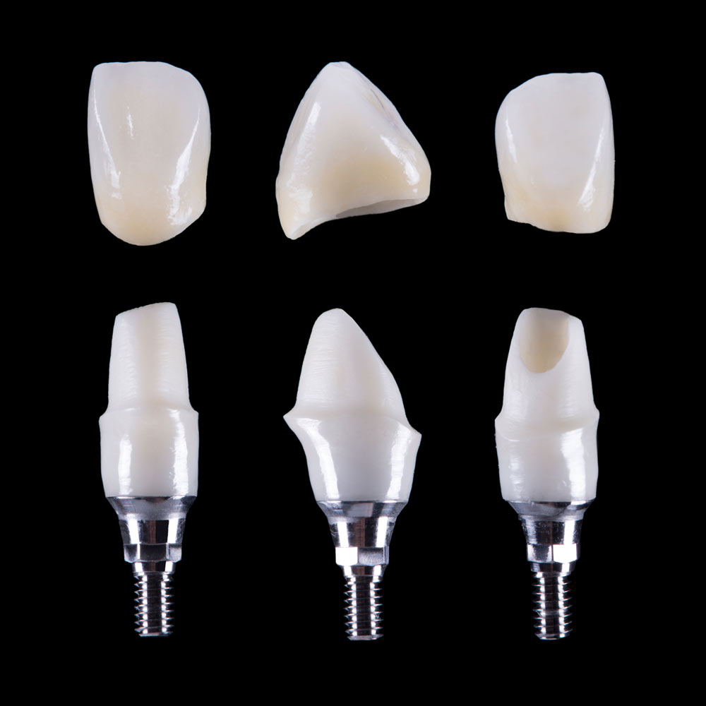 dental-implants-sq_1314984788